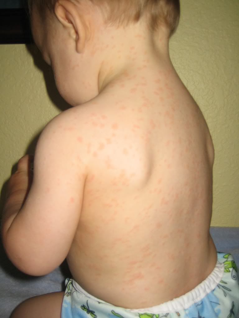 Measles Vaccine Rash