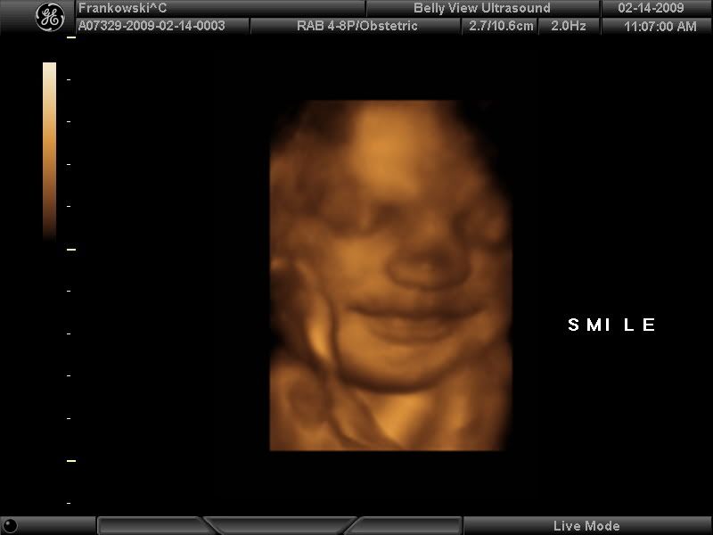 3D ultrasound.