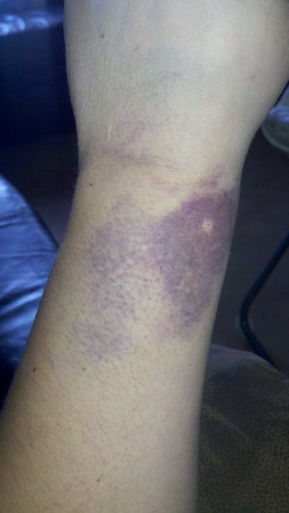 anyone-else-look-like-this-iv-bruising-babycenter